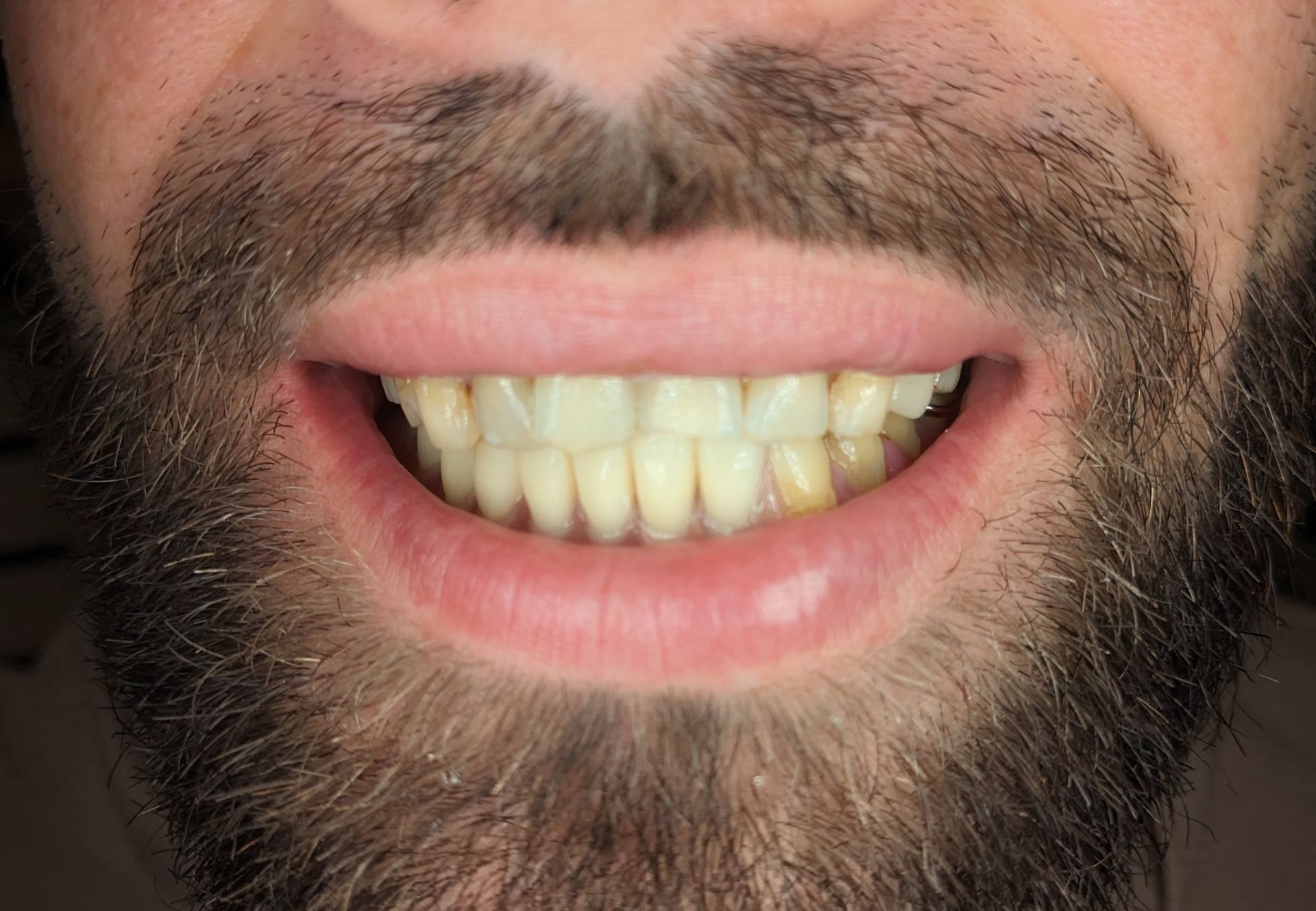 Dental Implant - After Tooth