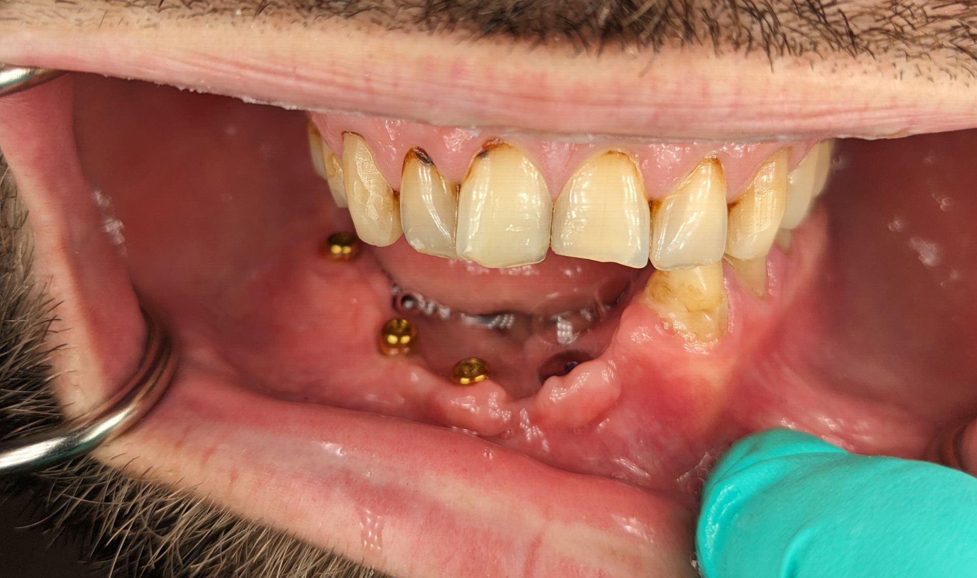 Dental Implant - Before Tooth