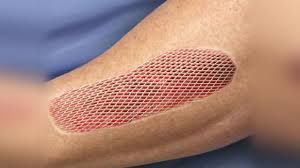 Skin graft for wound recovery treatment