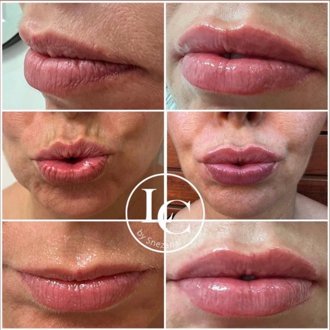 lip filler south yarra