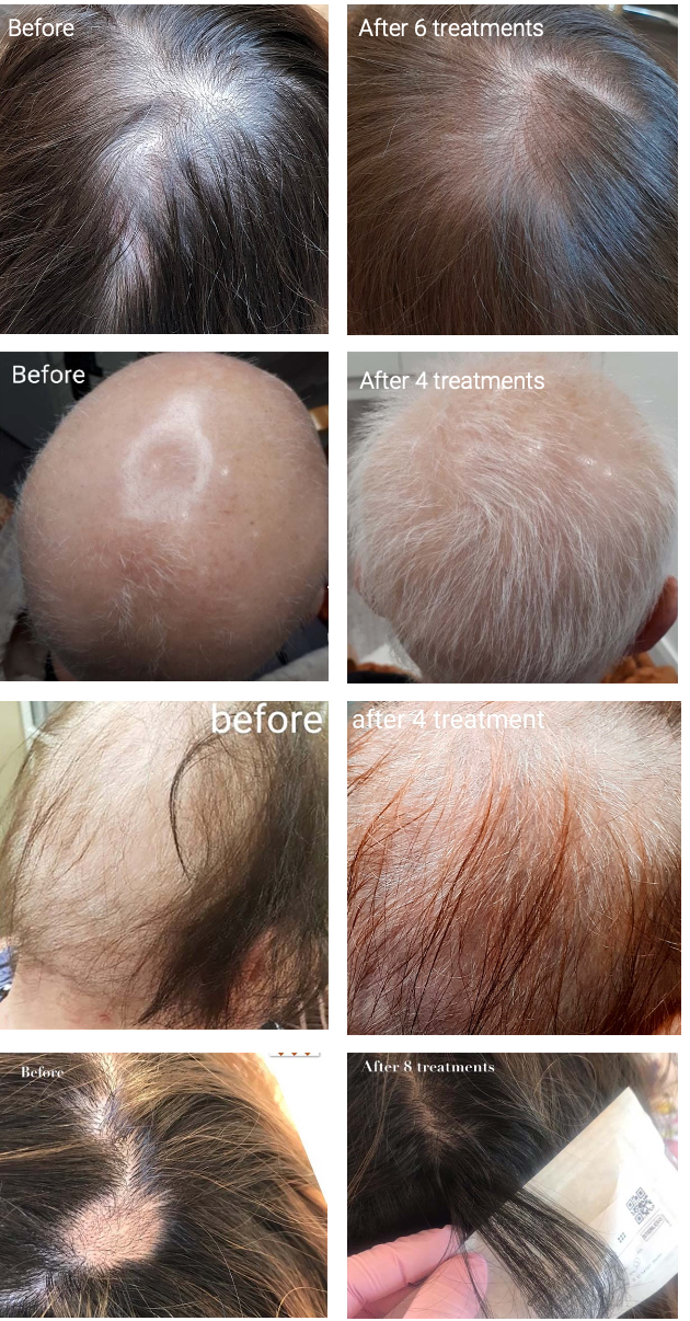 thicker stronger hair before and after mesoskinline treatments at HUSH CLINICAL south yarra treats balding and thinning hair