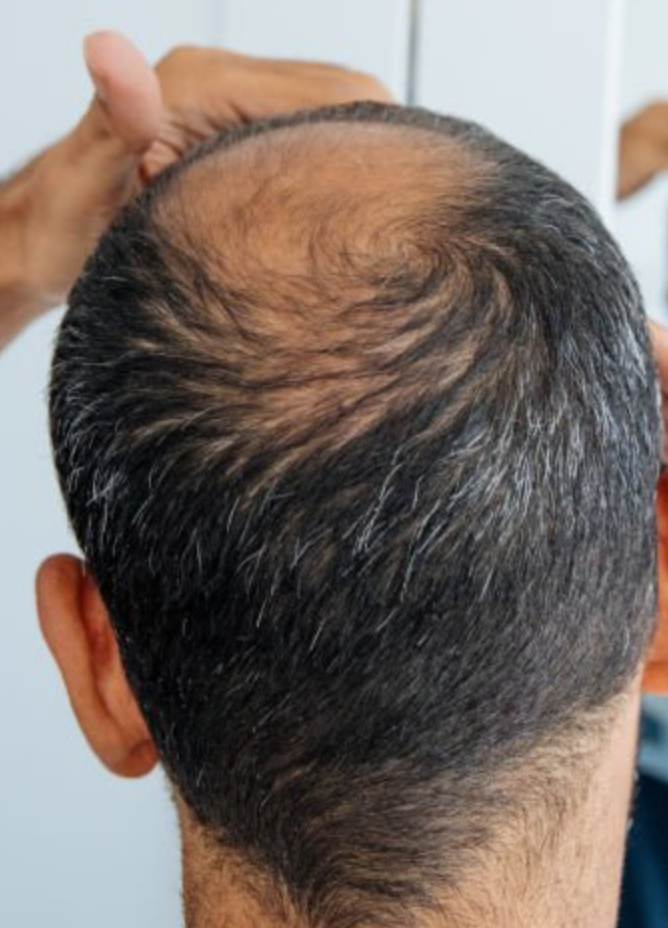hair loss thinning