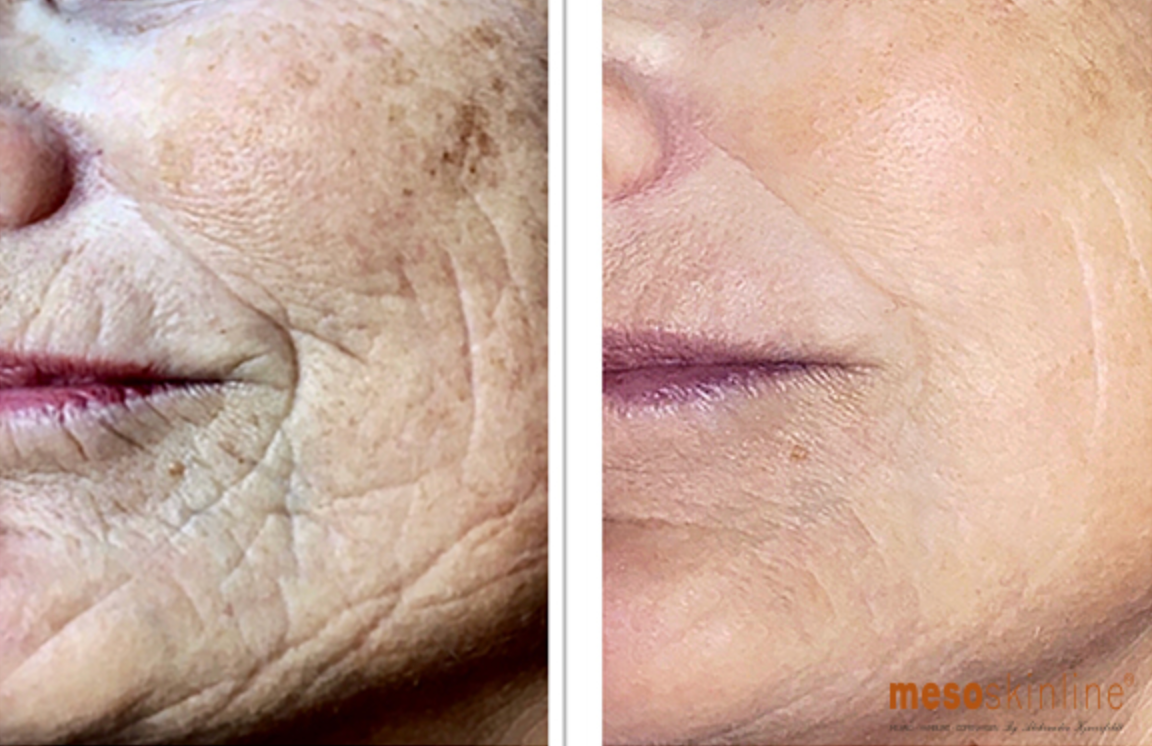 Split close-up of facial skin before and after smoothing treatment, showing wrinkles reduced on the right