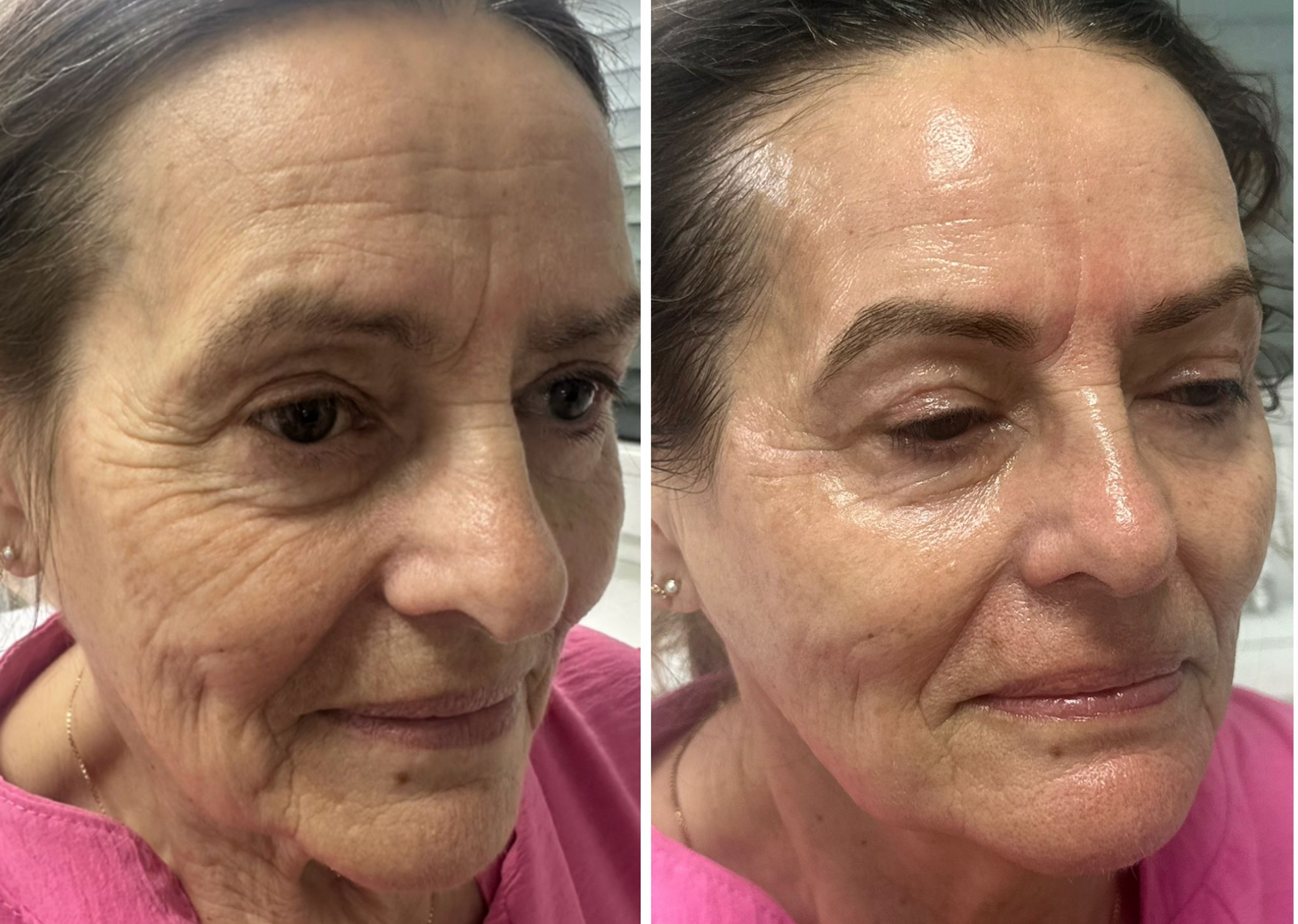 skin needling mesoskinline 8 treaments before and after
