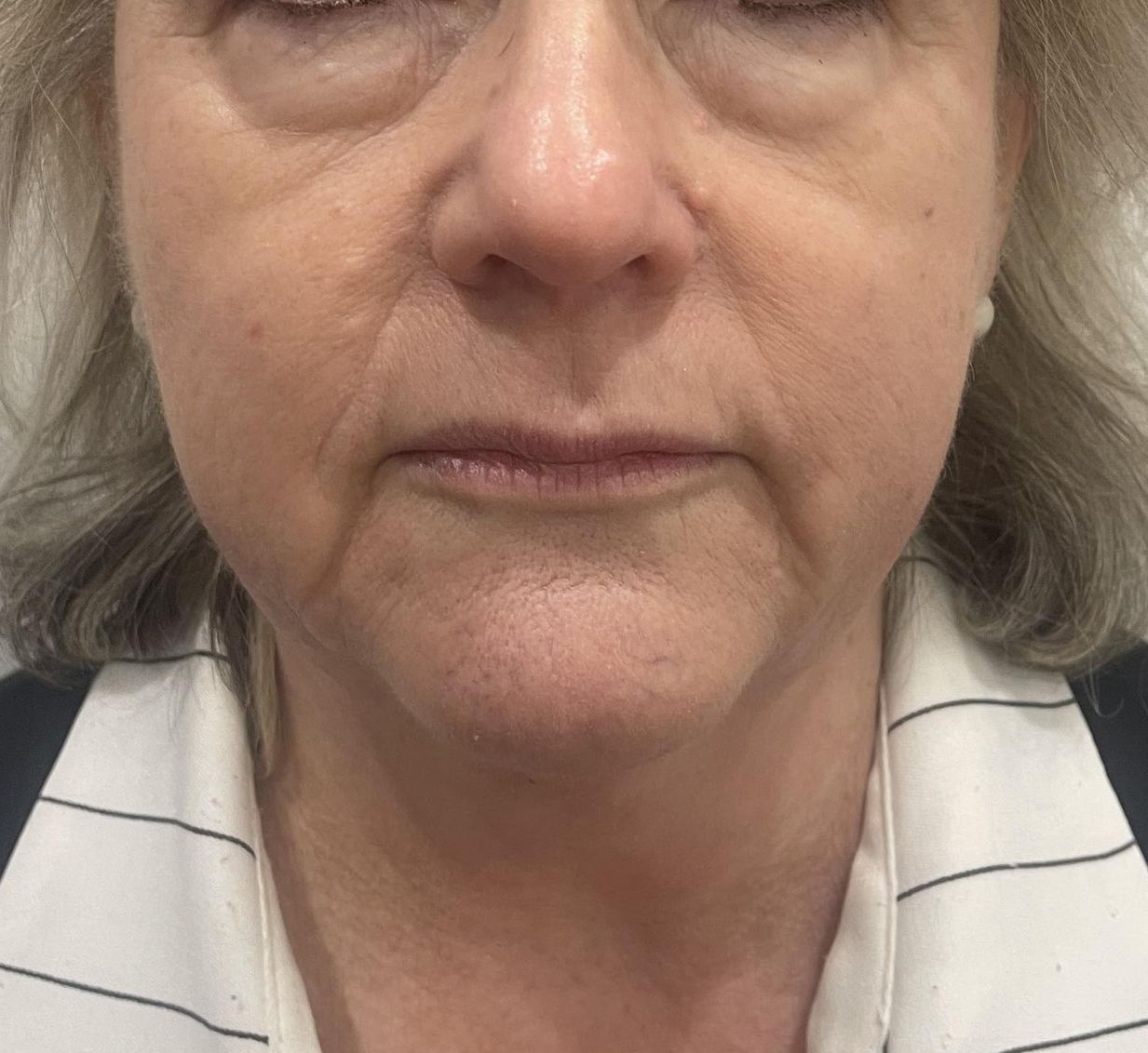 Skin tightening