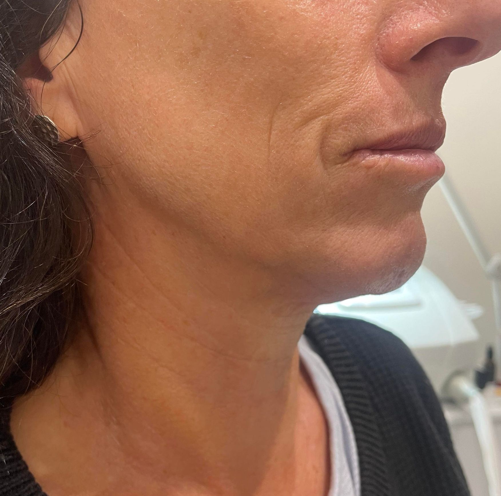 Side view of a person's face, showing chin, mouth, and nose. Some wrinkles visible.