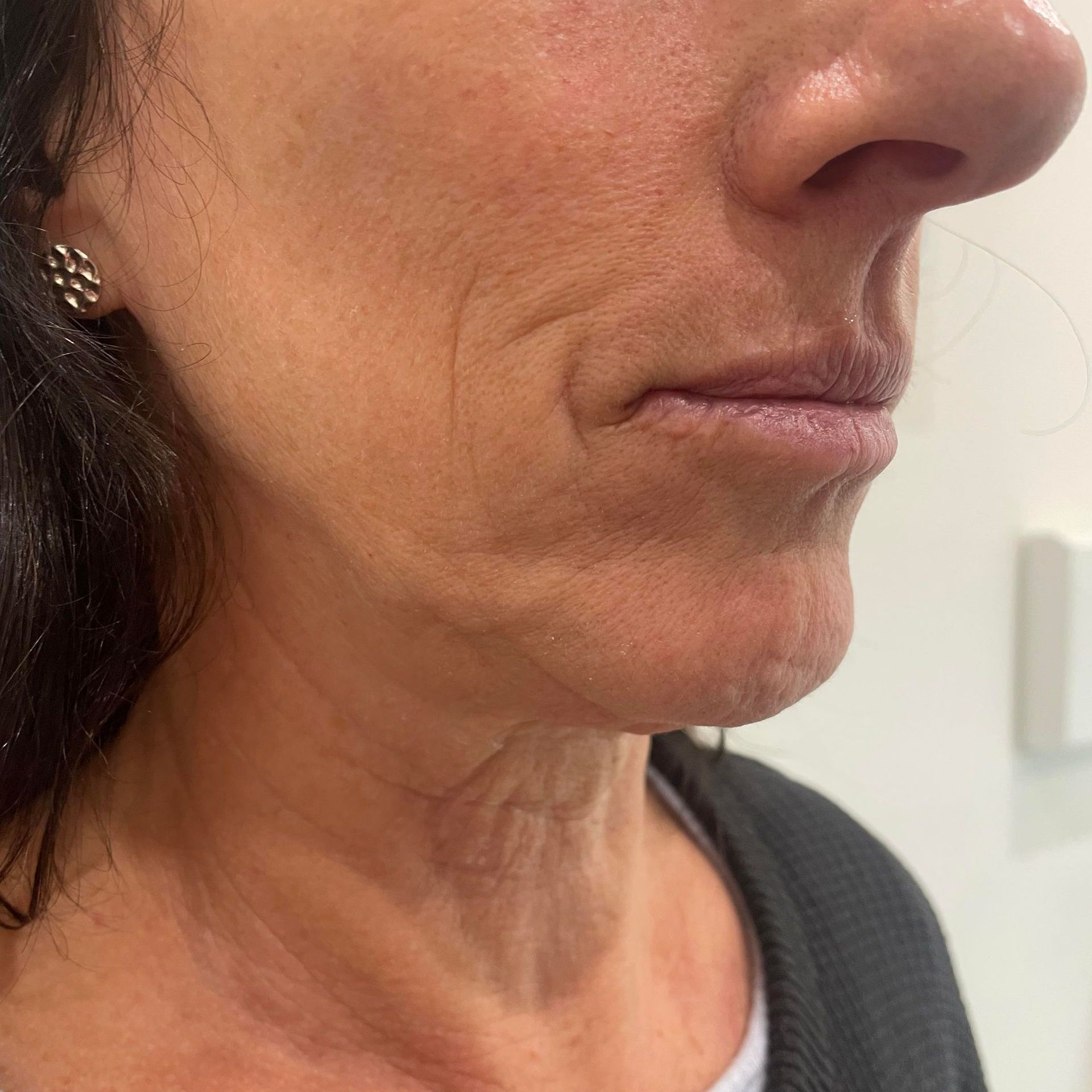 Close-up of a person's face showing skin texture, wrinkles around the mouth, and part of the nose and neck.