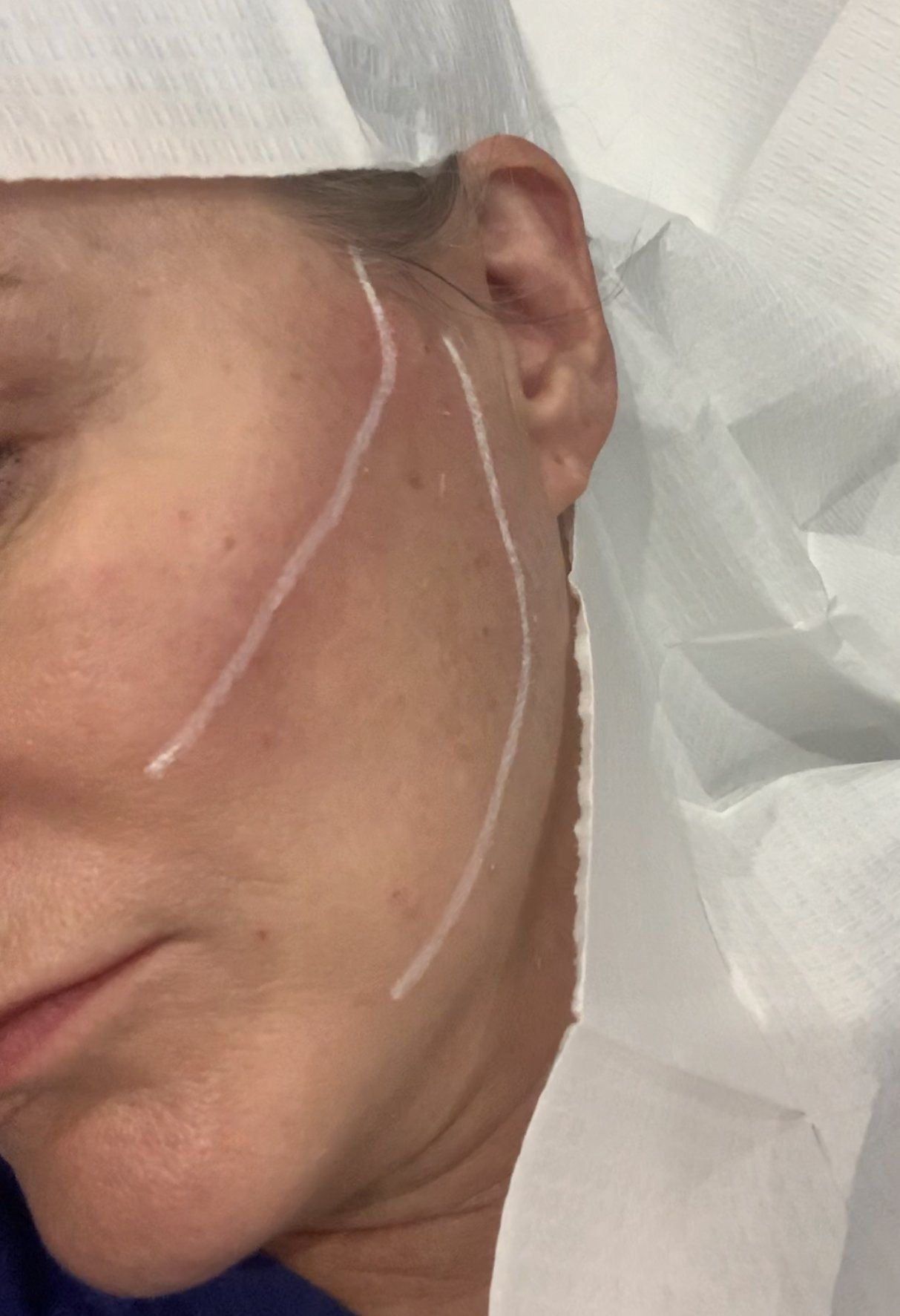 Threadlift