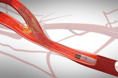 Carotid Stenosis treatment