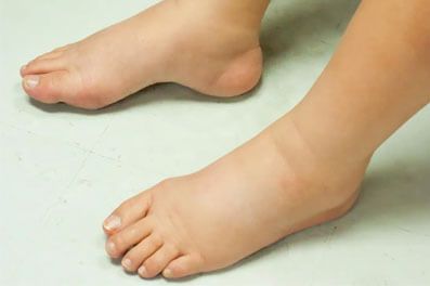 Leg Swelling and Lymphedema treatments