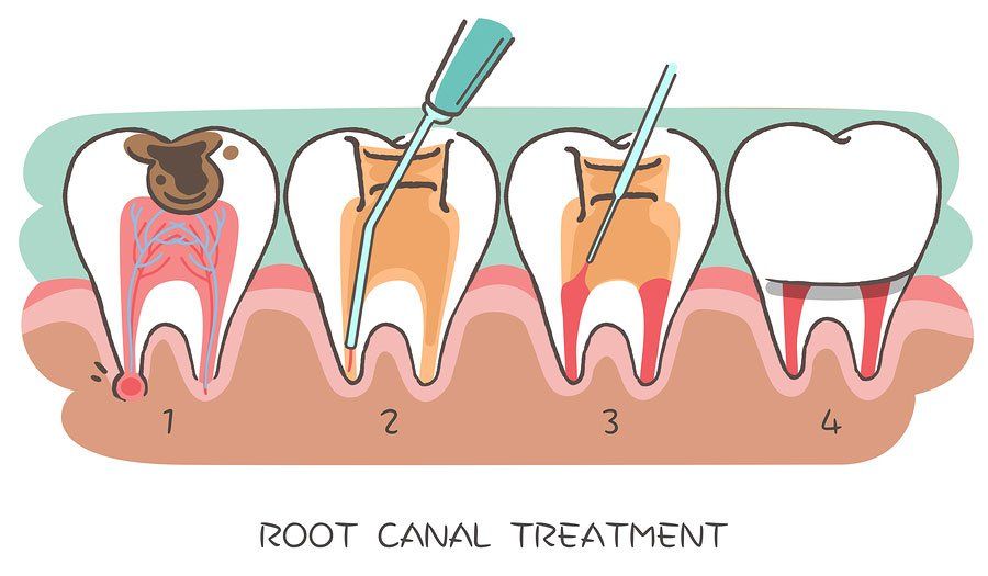 Dr. Jeffrey Wert & Associates, root canal