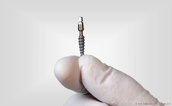 3D-Planung Implantation