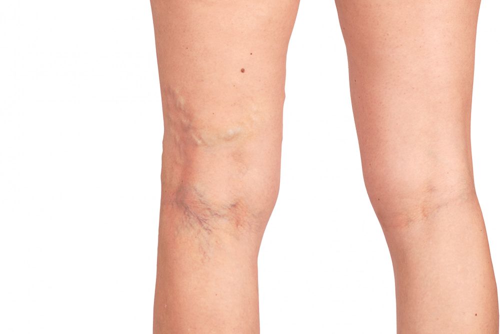 A woman 's legs with varicose veins on a white background.