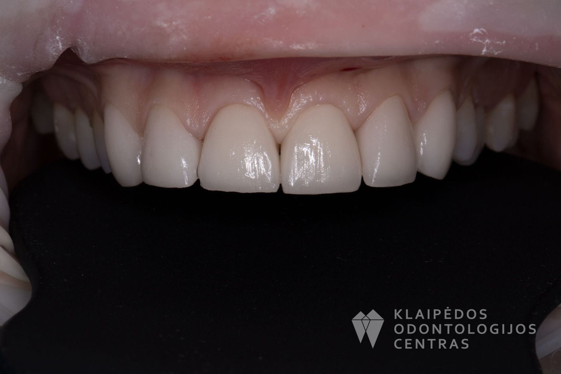 Dantų protezavimas Darbų galerija Klaipedosoc.lt
