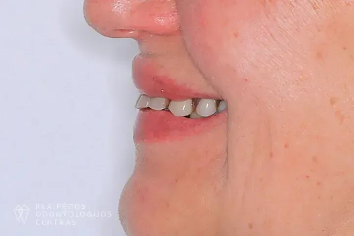 Pilnas žandikaulio atkūrimas ant 4-ių implantų
