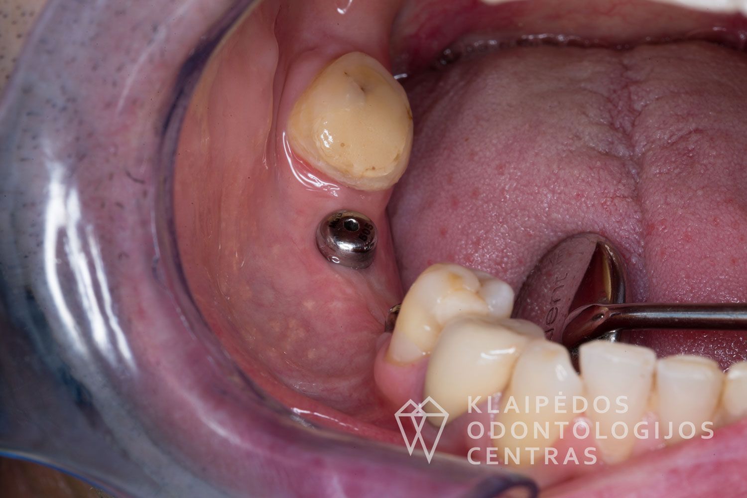 Cirkonio keramika ant implantų - prieš