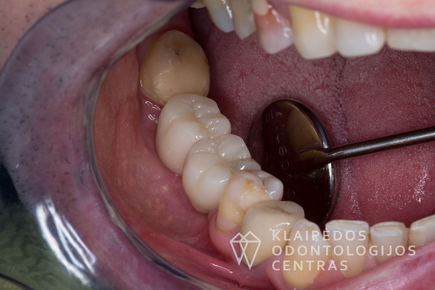 Cirkonio keramika ant implantų - po