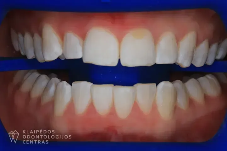 Dantų balinimas po