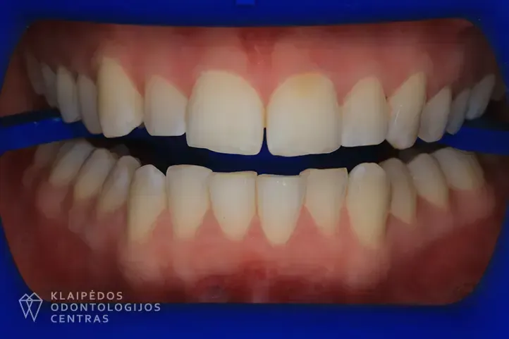 Dantų balinimas prieš