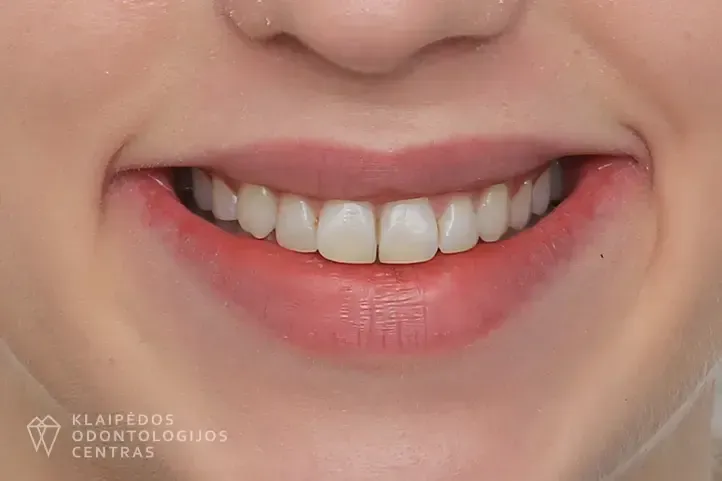 Dantų tiesinimas kapomis po