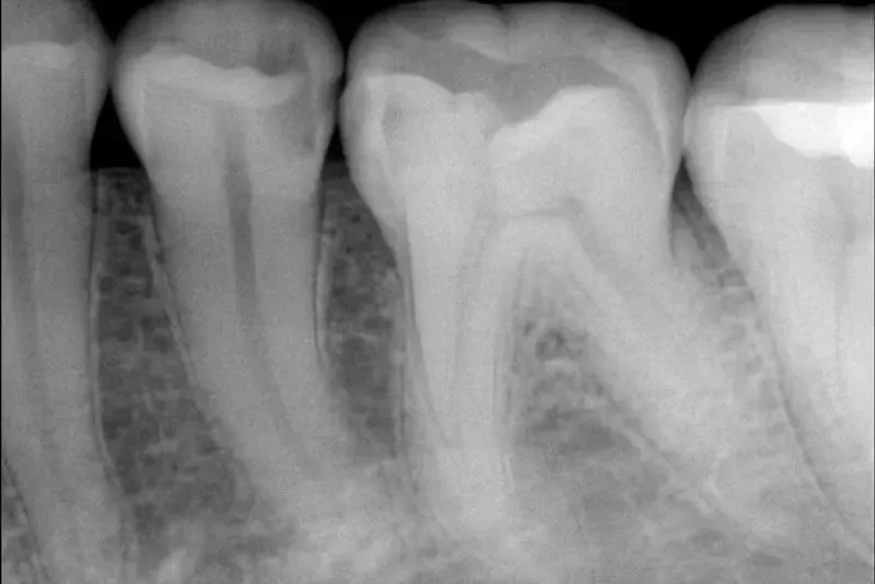 Dentalinė rentgeno nuotrauka Dentalinė rentgeno nuotrauka