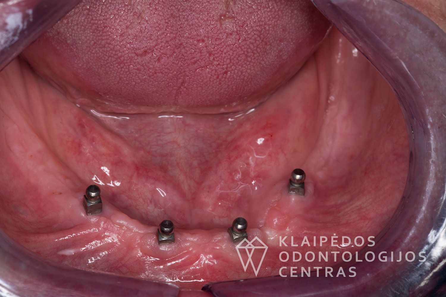 Plokštelė ant mini implantų - prieš