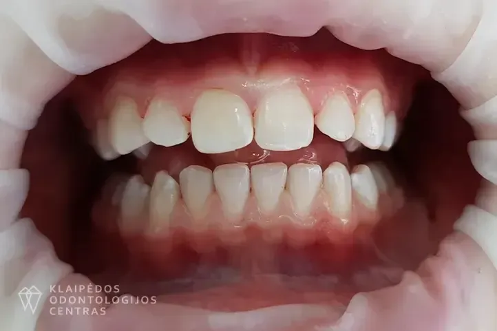 Profesionali burnos higiena po