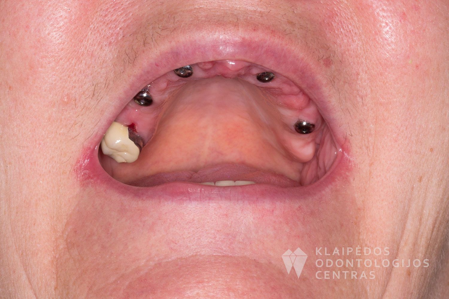 Implantacija