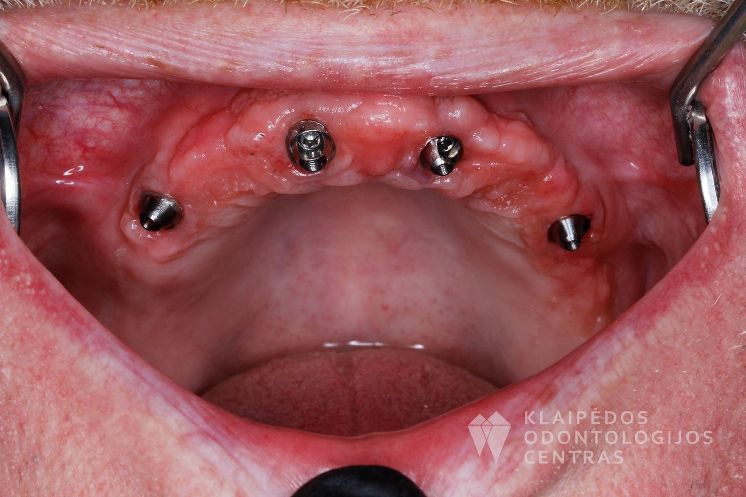 Implantavimas