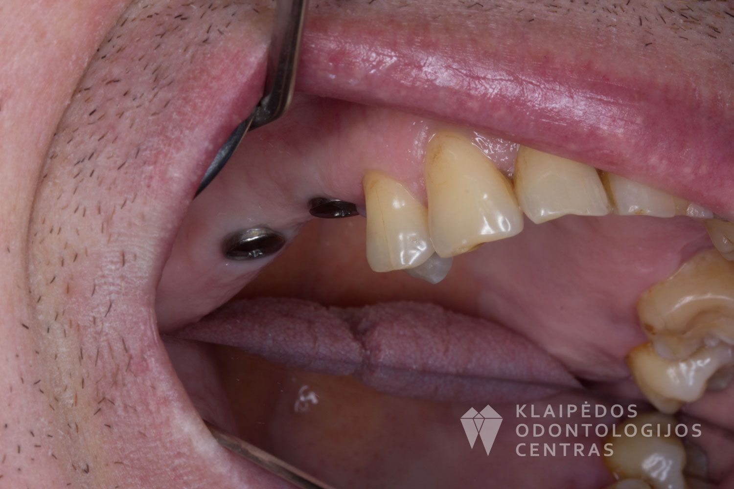 implantacija