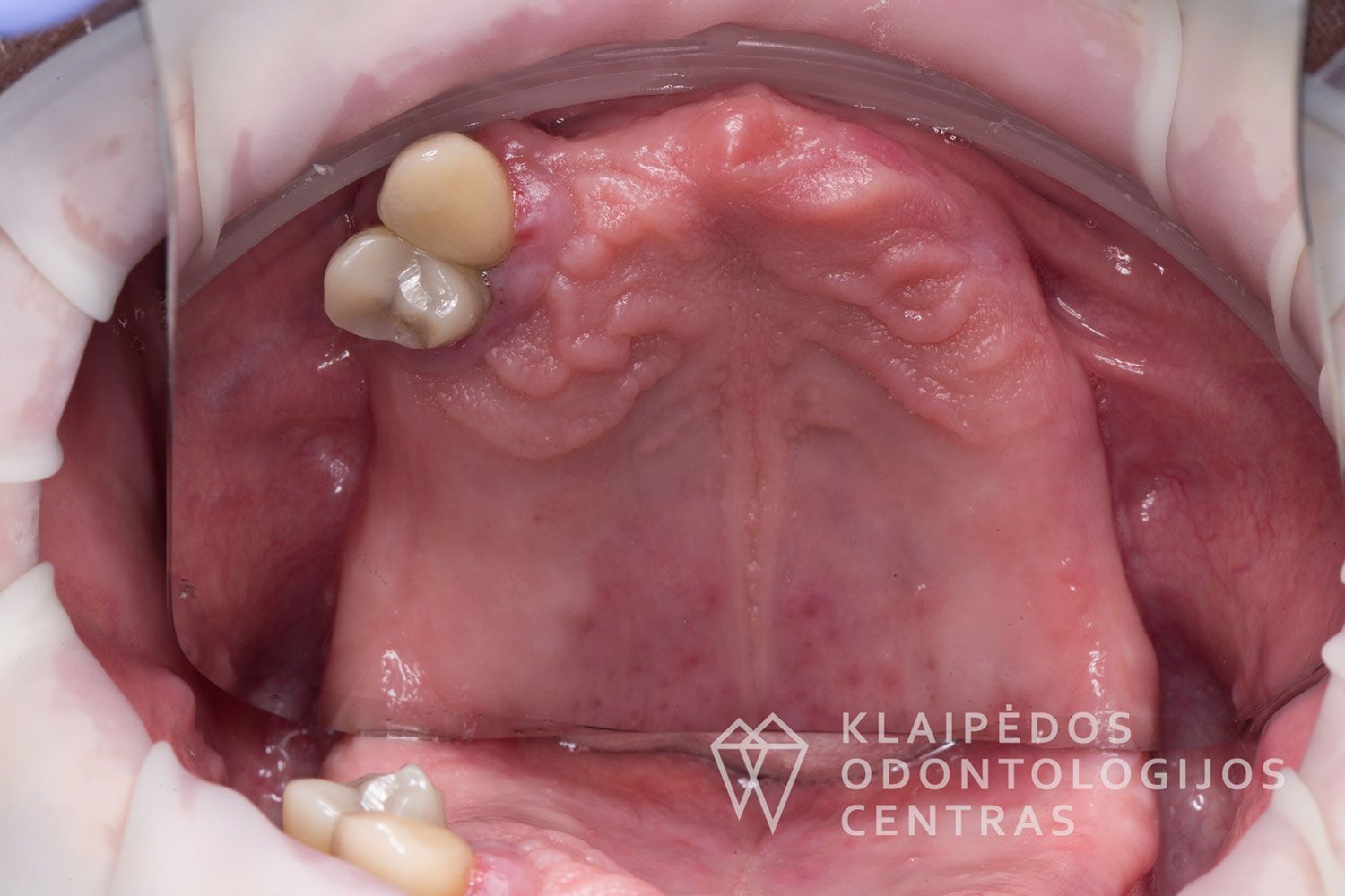 Implantavimas