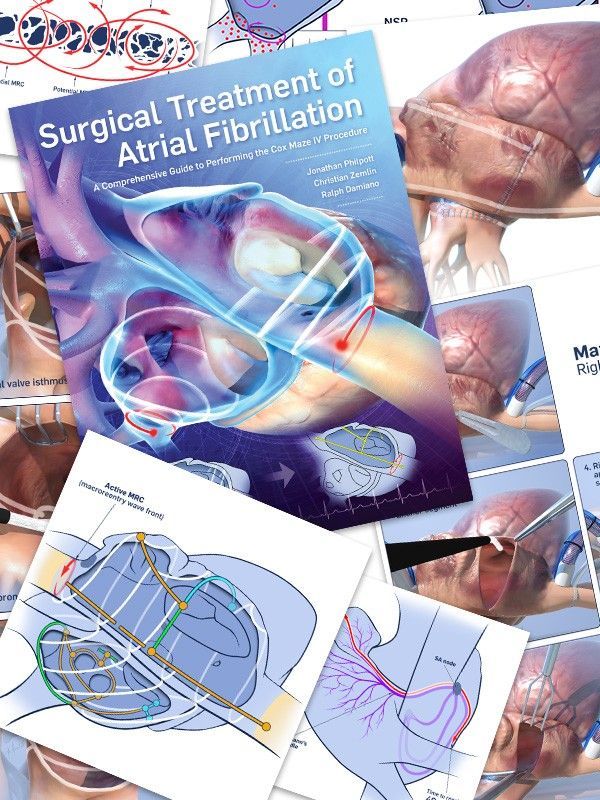 Wide array of graphics to support multiple approaches to treat atrial fibrillation.