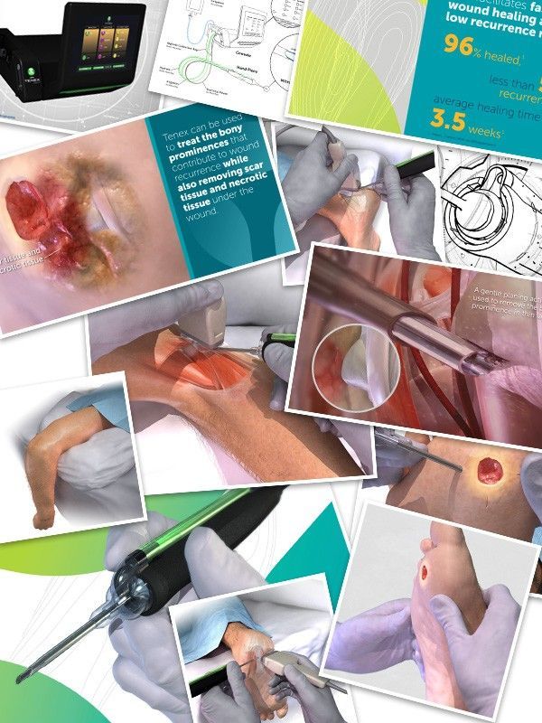 Multiple graphic solutions including line drawings, illustration, animation, and graphic design for a medical device company.