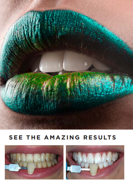Our teeth whitening system are Suitable for all types of teeth