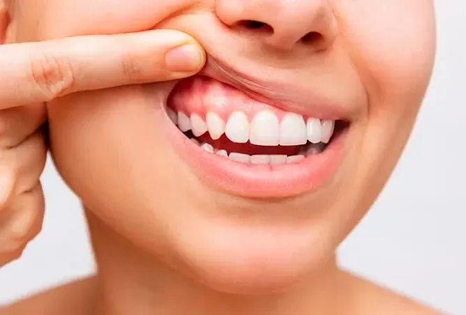 Finger pulling back upper lip to show straight white teeth and a smile