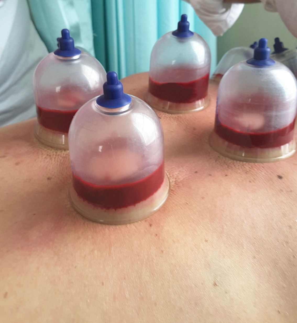 Wet Cupping 