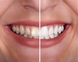 Tela dividida mostrando um sorriso com dentes amarelados à esquerda e dentes brancos e brilhantes à direita.
