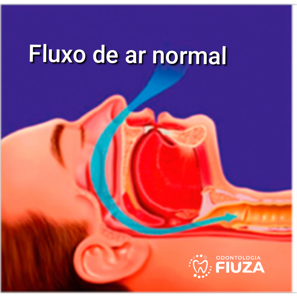 Apneia do sono