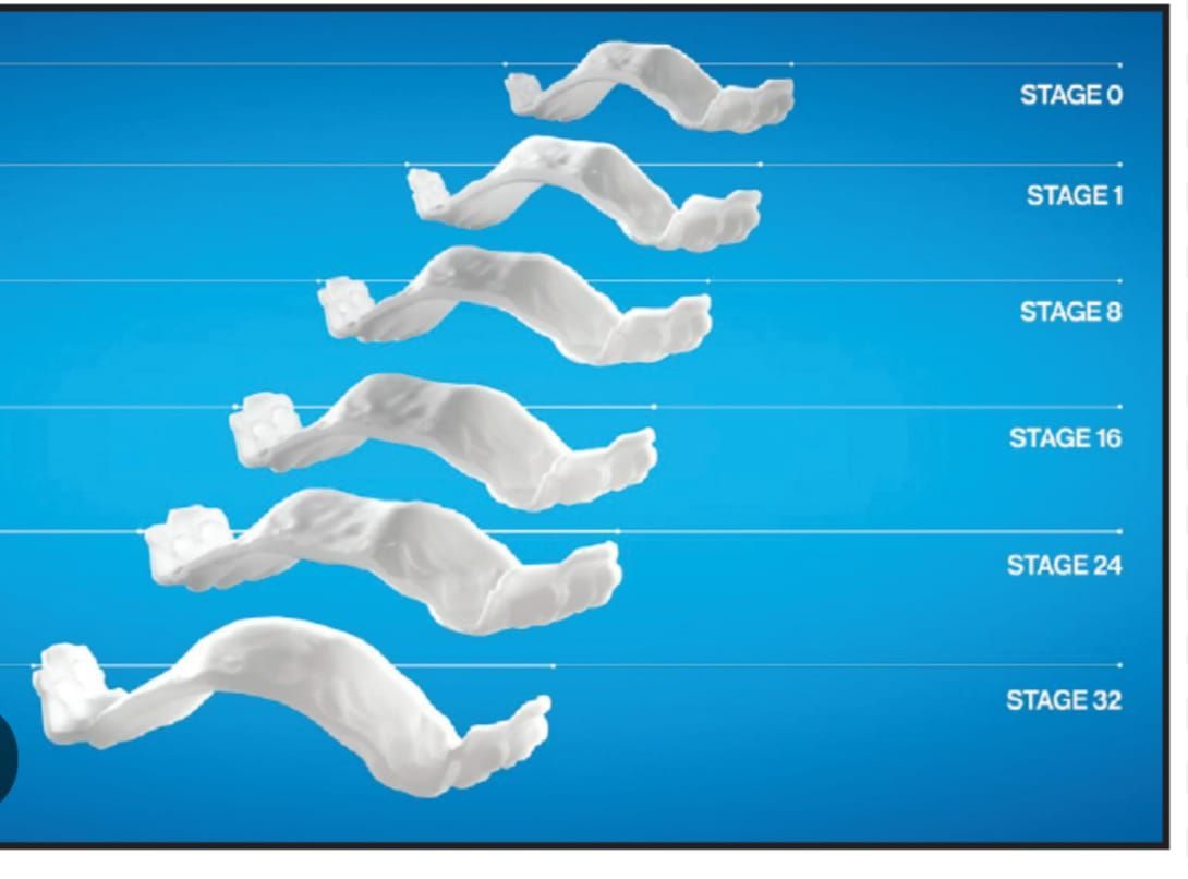Palatal expander 