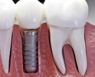Um diagrama em close-up mostra um implante dentário inserido no osso maxilar, suportando uma coroa dentária artificial.