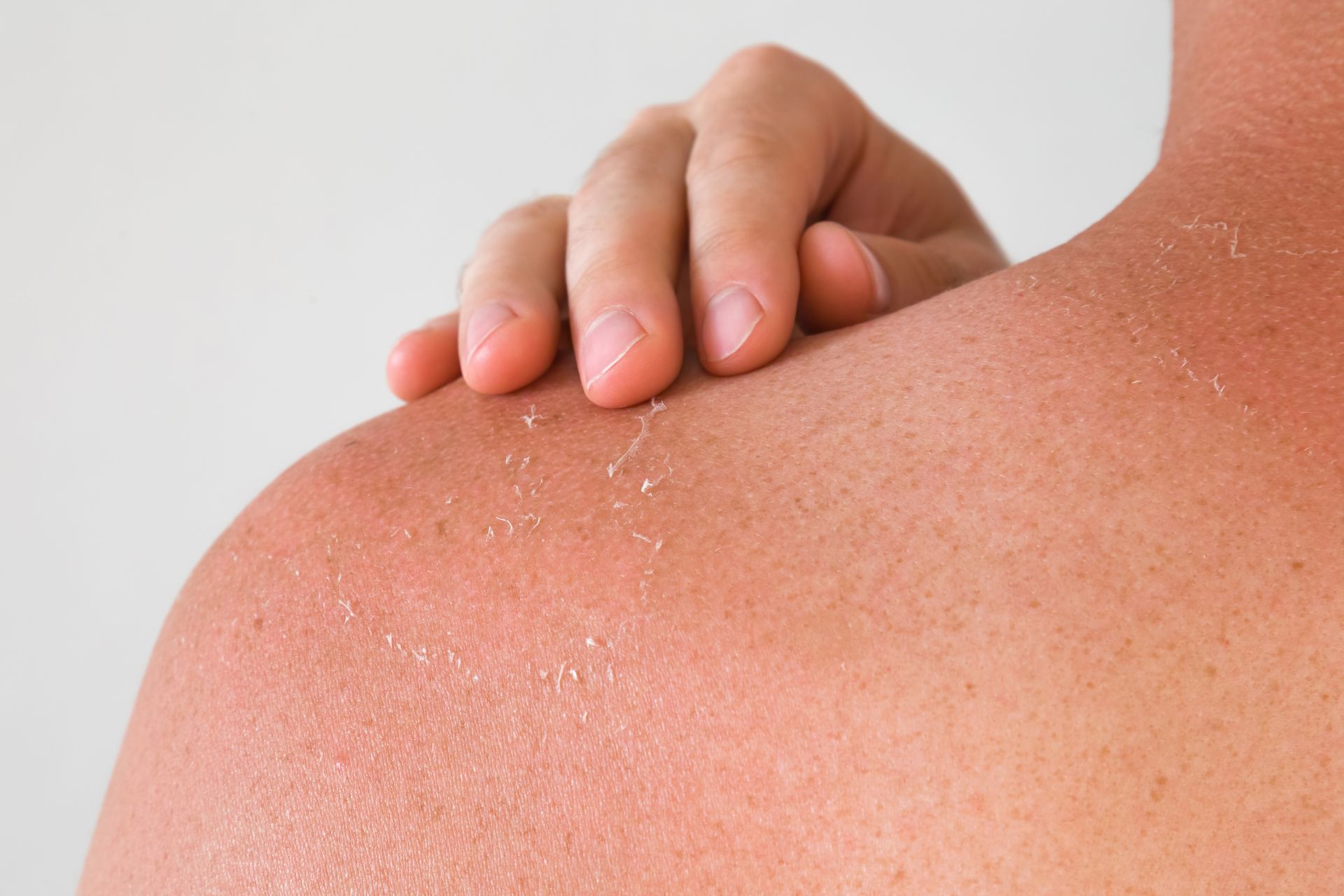 Hand scratching a sunburned shoulder with peeling skin