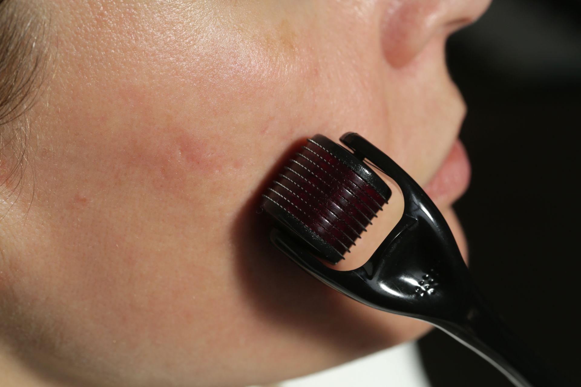 Derma roller pressed against a person’s cheek, with small microneedles visible.