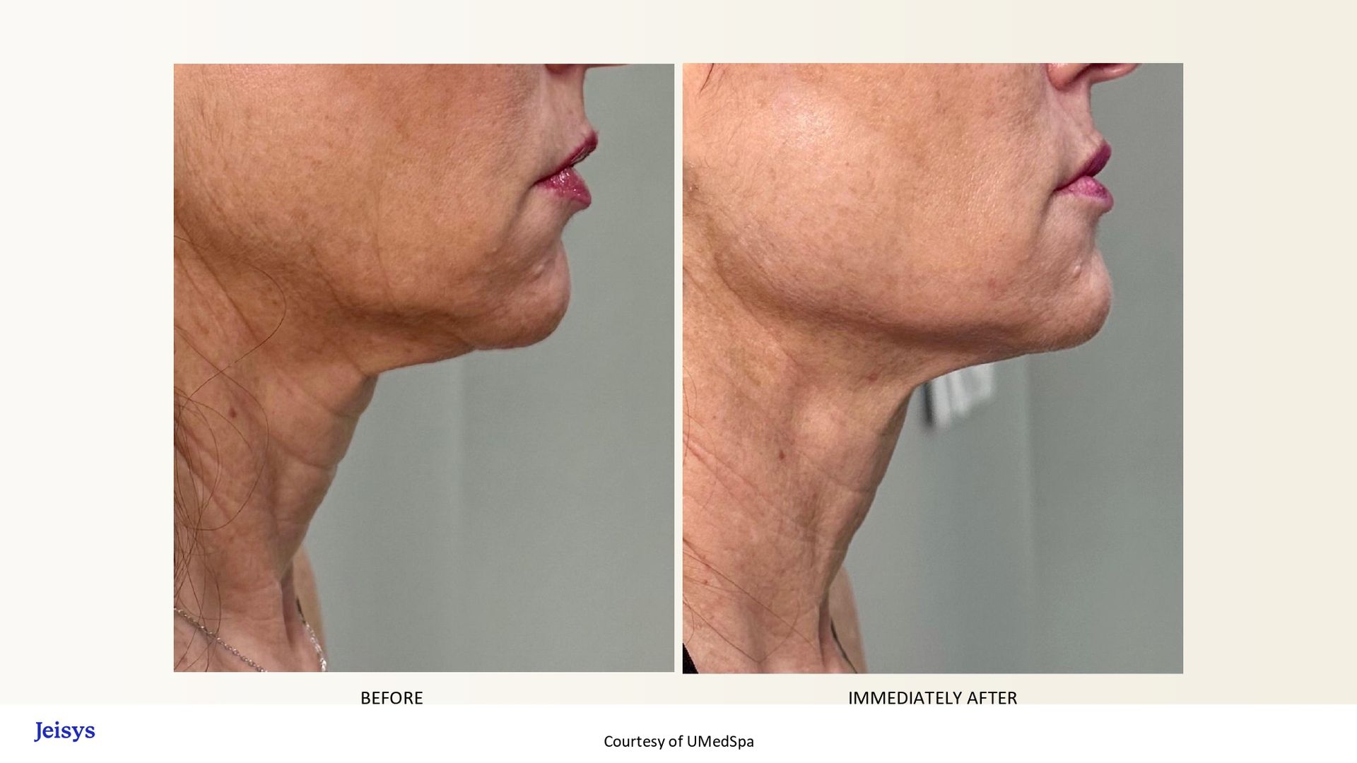 Side-by-side comparison of a person's neck and chin before and after a cosmetic procedure. Skin appears tighter in the after photo.