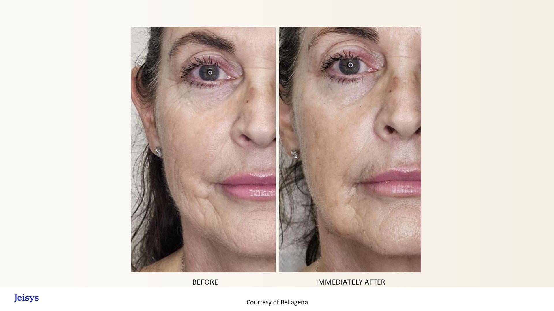 Side-by-side comparison of a woman's face: before and after skincare treatment, showing reduced wrinkles and improved skin tone.
