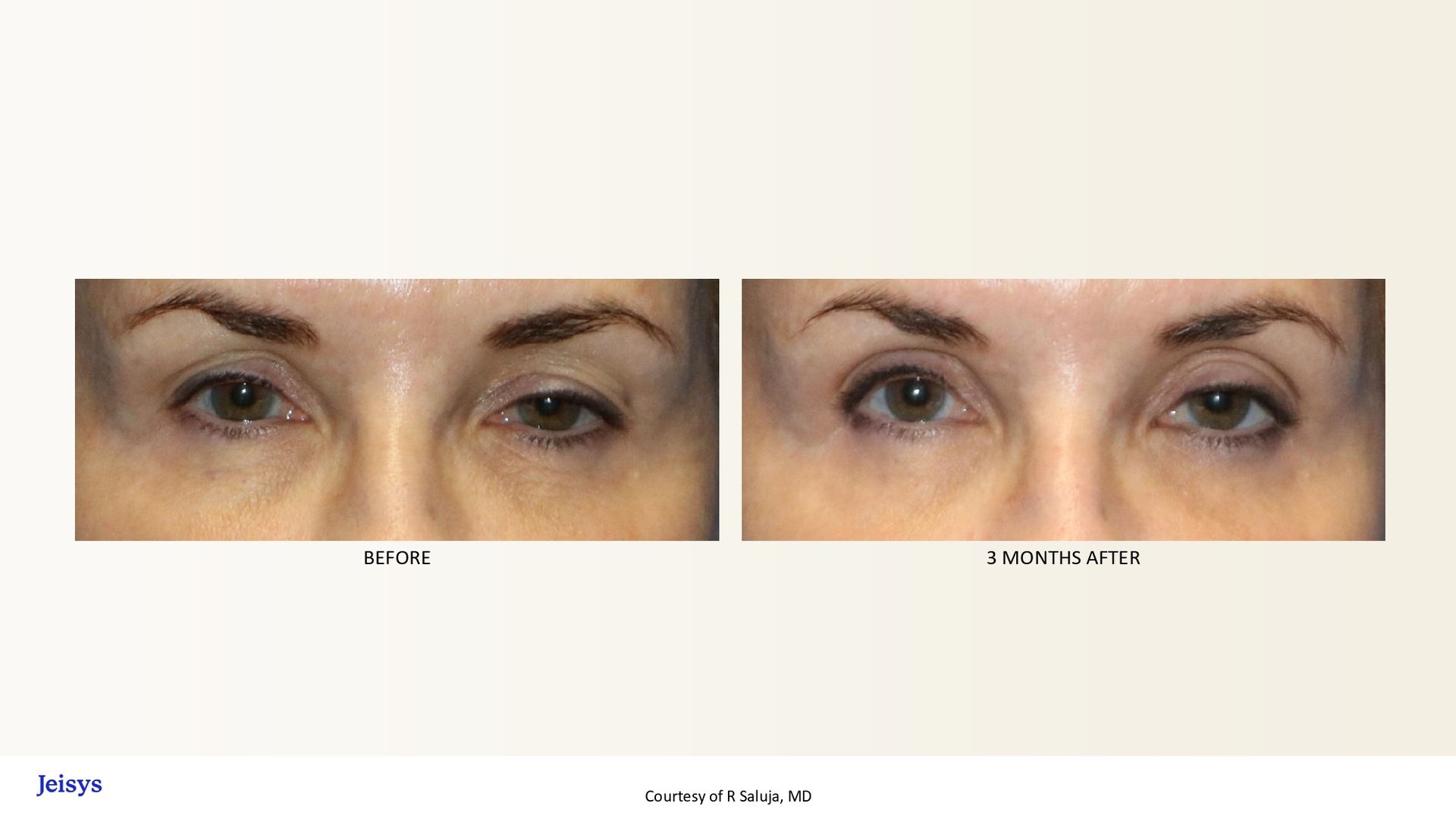 Before-and-after eyes: Left eye area shows wrinkles. Right image shows smoother skin after treatment.