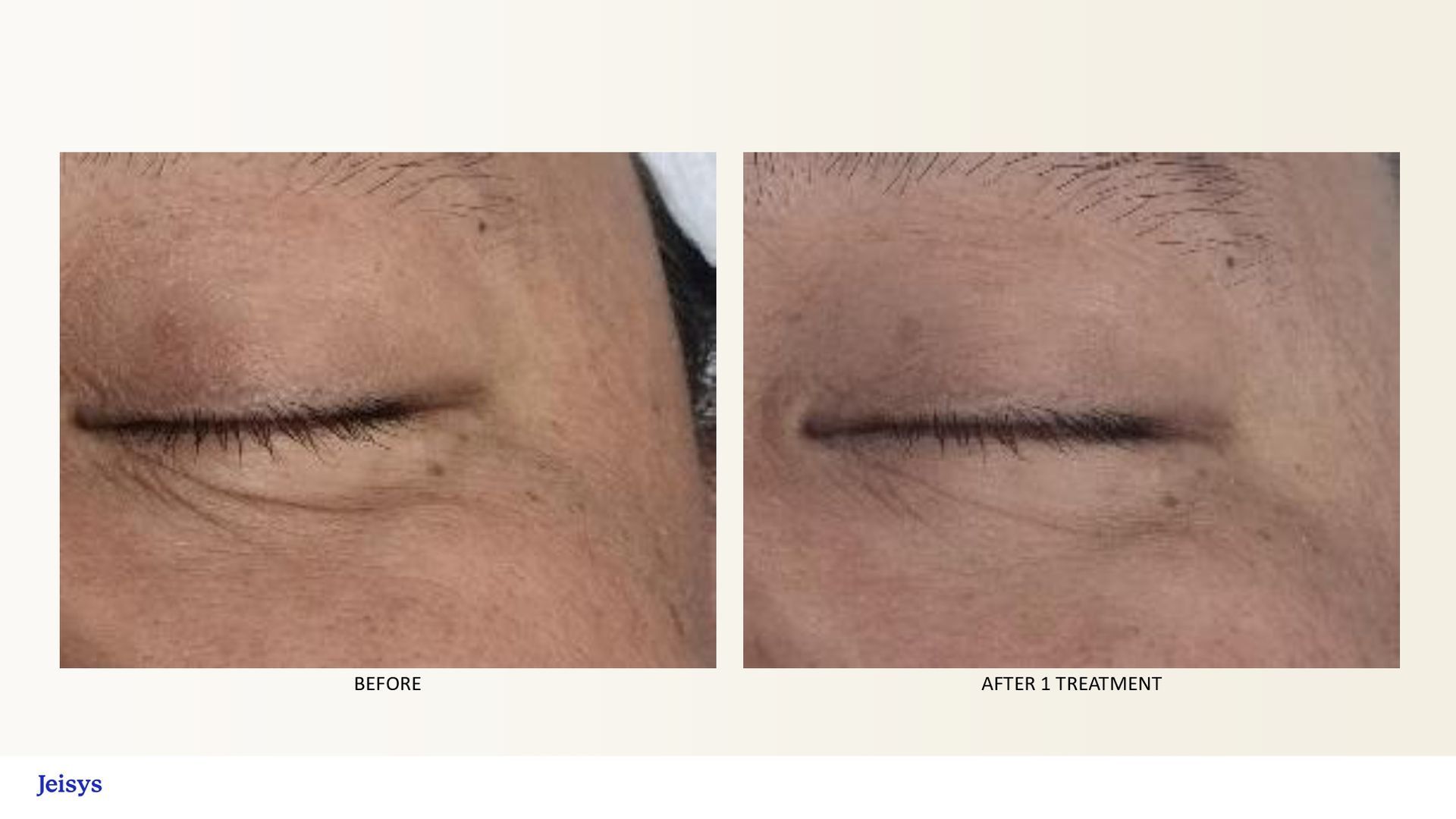 Before-and-after photos of a closed eye show reduced wrinkles after treatment.