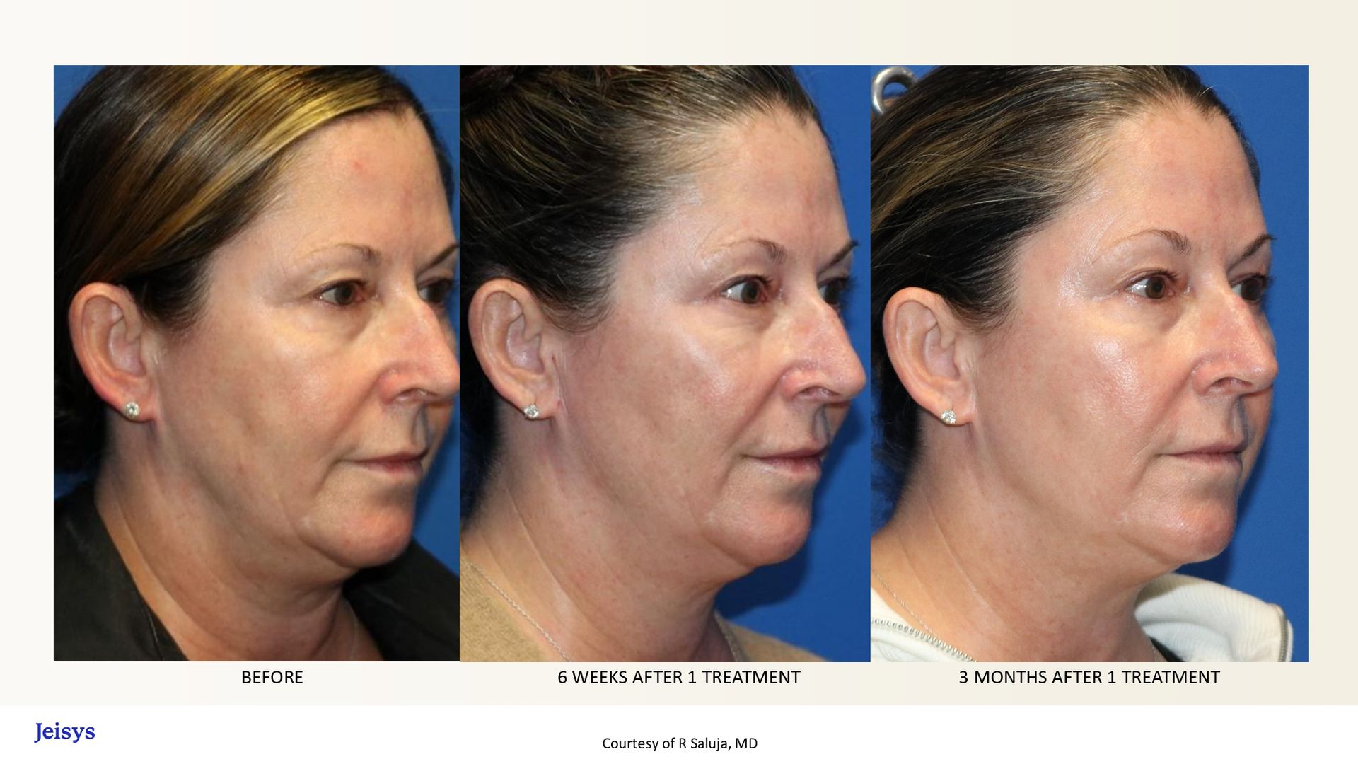 Facial rejuvenation before, immediately after, and a few months after surgery of a woman in profile.
