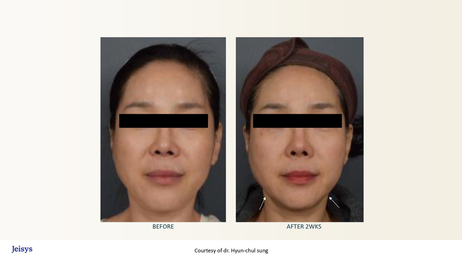 Comparison photos of a woman's face before and after a cosmetic procedure, with visible skin tightening.