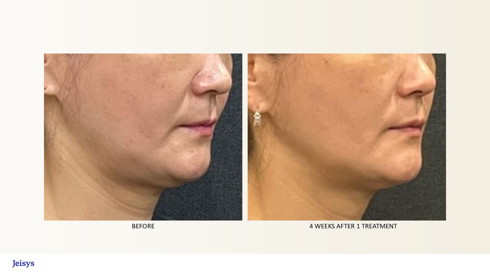 Profile view of a woman's face before and after a cosmetic procedure, showing reduced skin laxity and improved jawline definition.