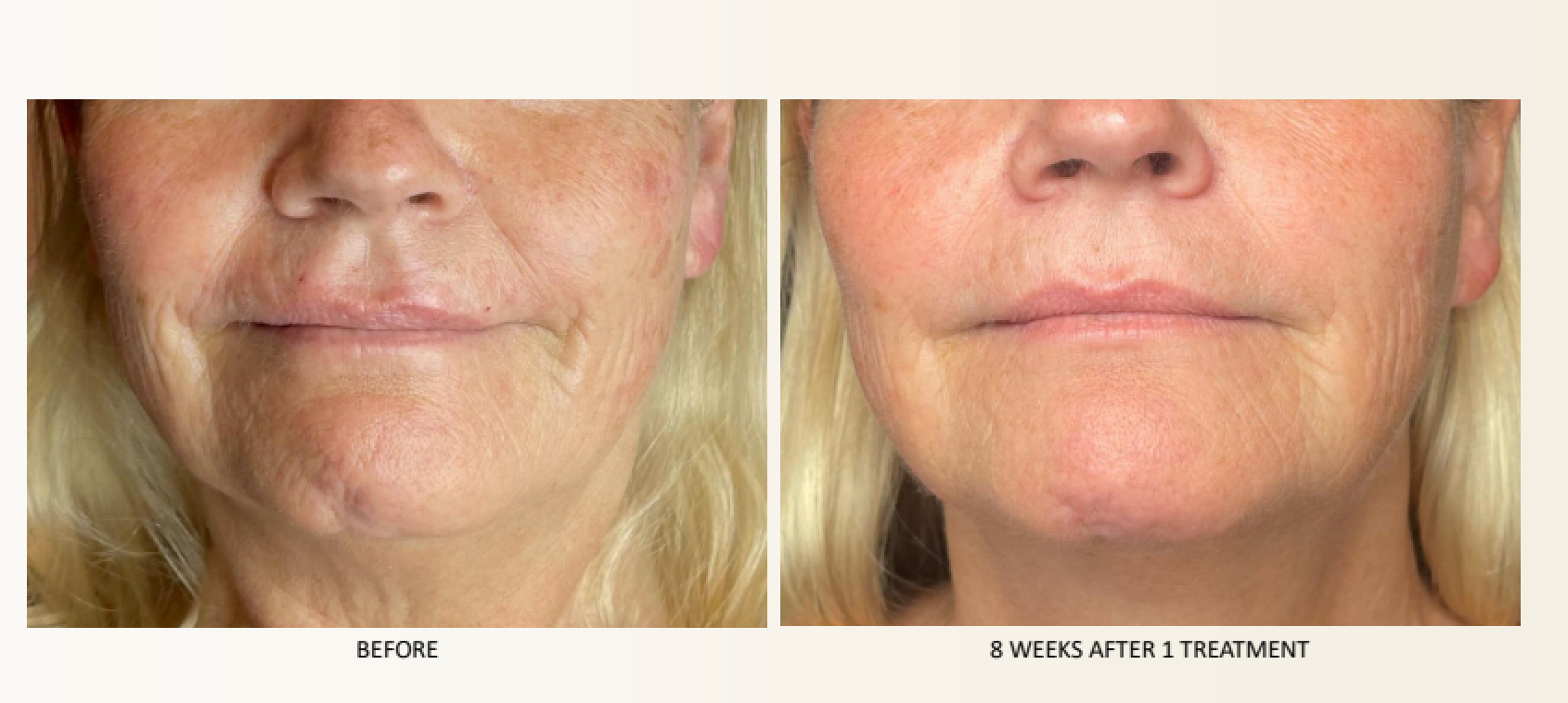 Side-by-side comparison of woman's face before and after treatment, showing reduced wrinkles and smoother skin.